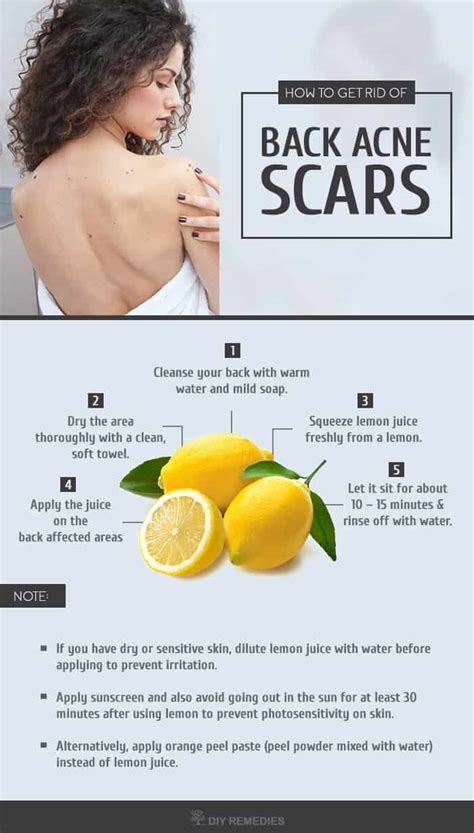 How to get rid of acne scars: your ultimate guide